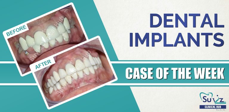 Full Mouth Rehabilitation Using Dental Implants