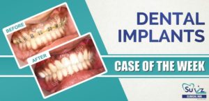Dental Implant in the esthetic region following autogenous block graft