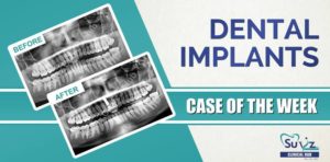 Rehabilitation of discolored tooth